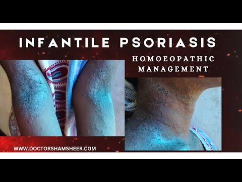 INFANTILE PSORIASIS