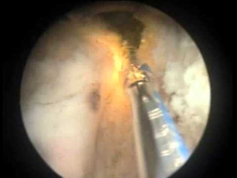 Vaporisation photosélective de la prostate (VPP) au laser Greenlight