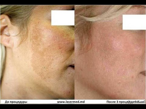Как ухаживать за кожей с пигментными пятнами на лице Маска для лица для удаления пигментных пятен