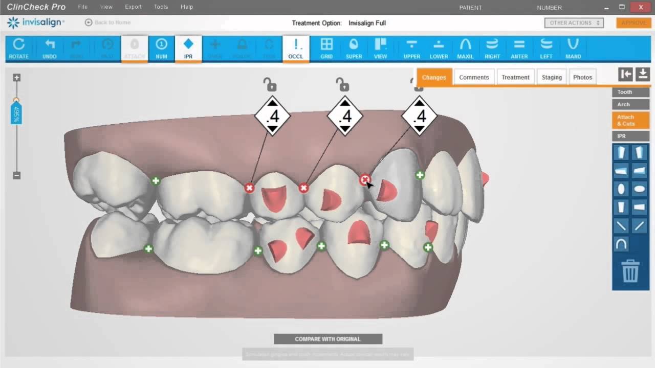 ClinCheck Pro Ajustes Dentários - Sistema Invisalign - Blumenau SC