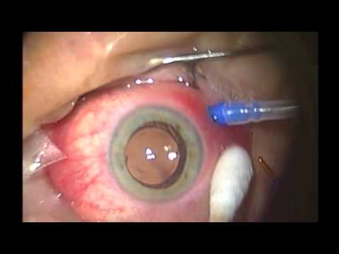 Macular Pucker Surgery, Vitrectomy with Epiretinal Membrane Peeling