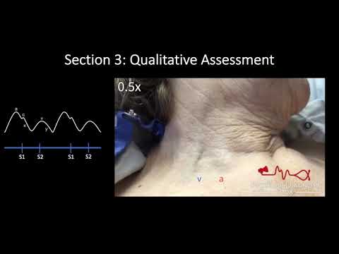 Jugular Venous Pulse: Qualitative Assessment