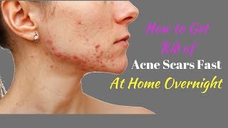 How to Get Rid of Acne Scars Fast at Home Overnight