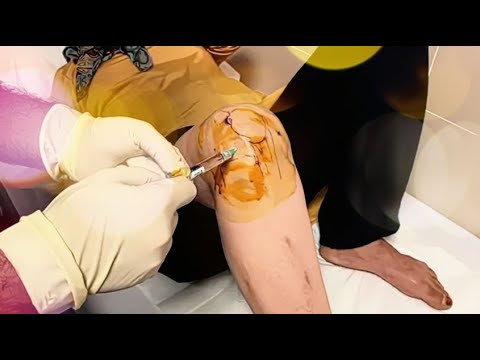 Knee Injection (Viscosupplement) - Video - Orthobullets