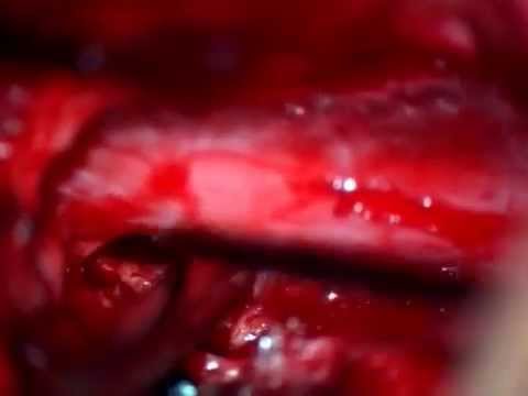 Verruche su gomiti e le articolazioni Tosse mal di collo da dietro e la sua testa
