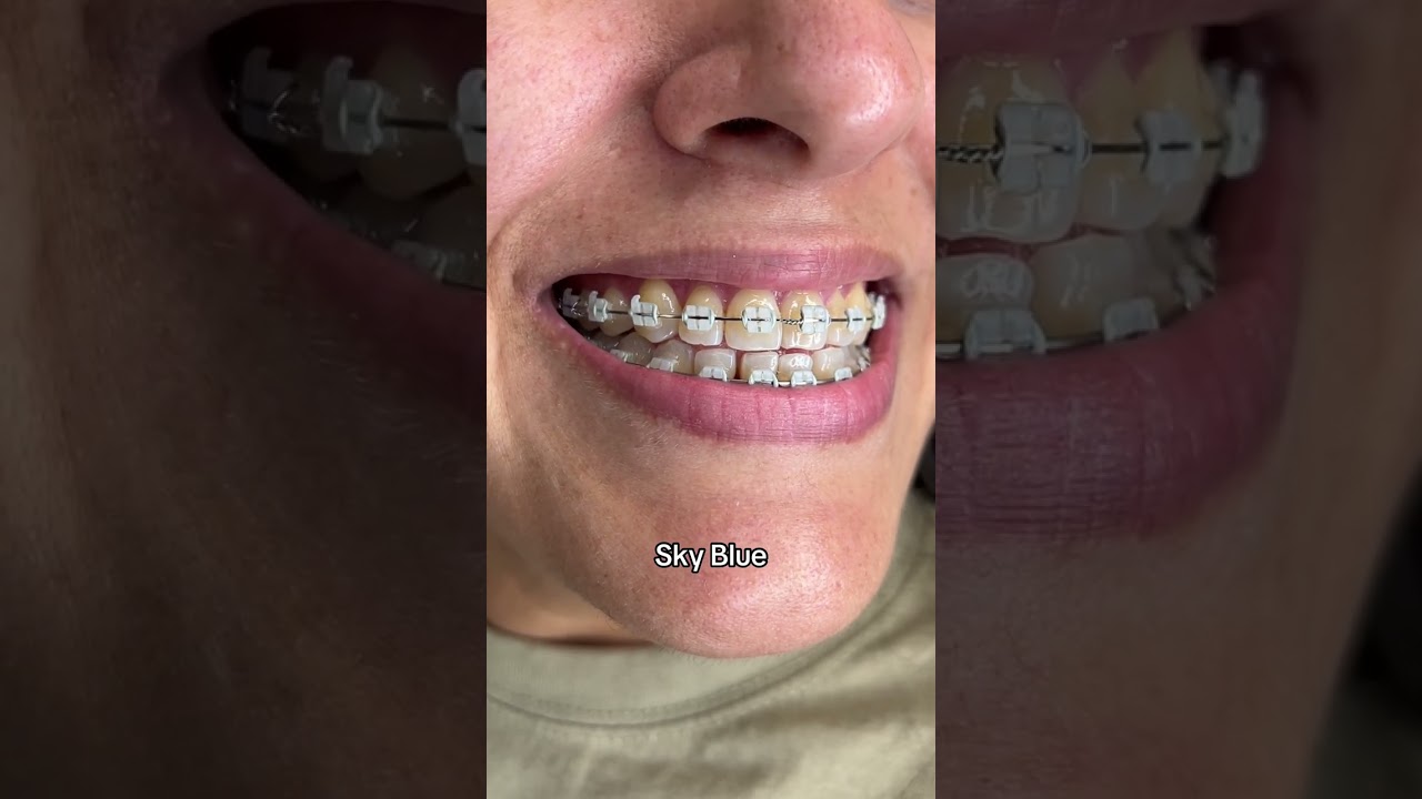 Braces Colors Before and After 8 weeks