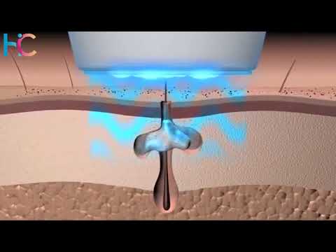 Acne Laser Pen Soft Scar Removal Machine Blue Light Therapy