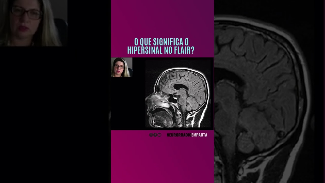 O que significa hipersinal no FLAIR O brilho nessa sequência pode ter vários significados, assista