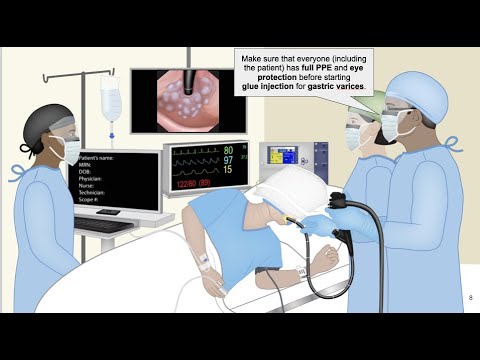 HCC 1475-29-Cyanoacrylate glue for gastric varices