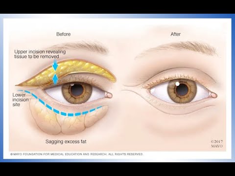 What to expect with an eyelid lift