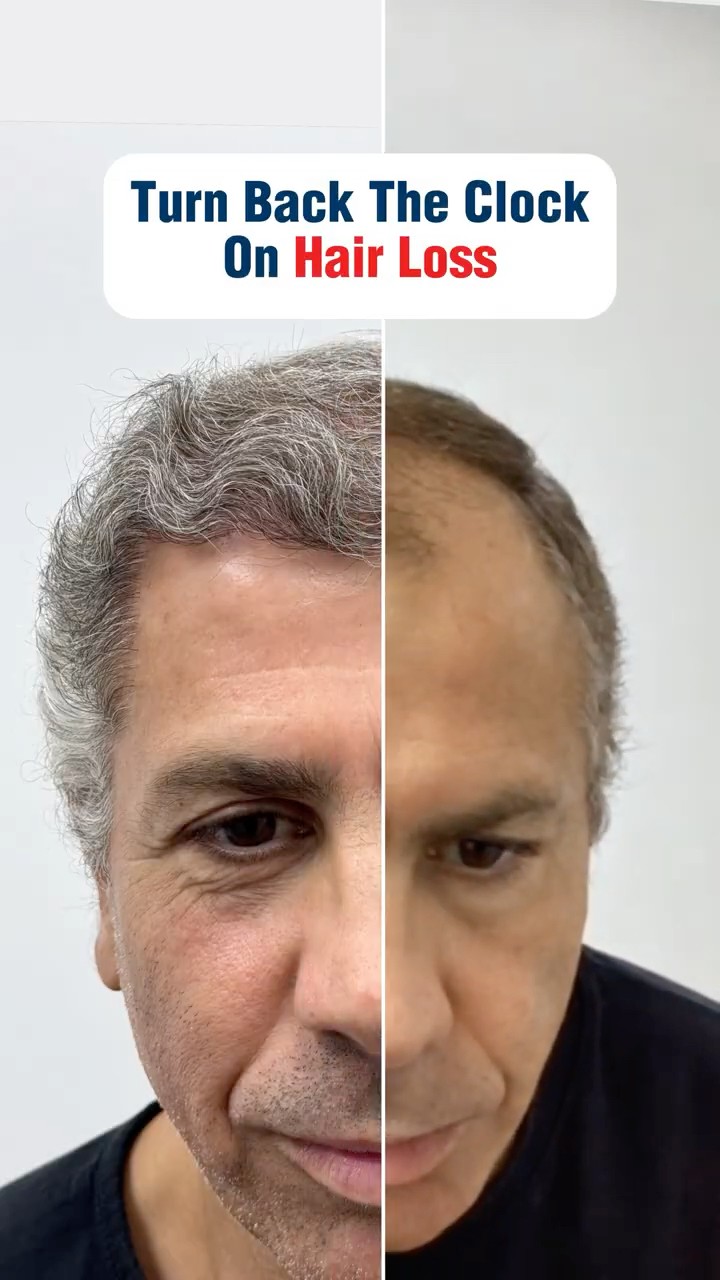 Hair Transplant Transformation