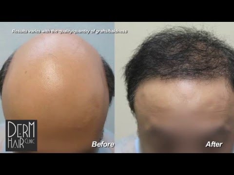 Los Angeles FUE hair restoration and Body hair...