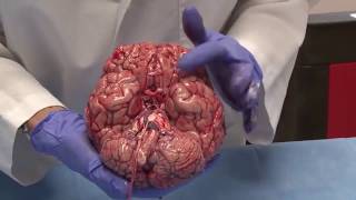 Fresh Human Brain Autopsy