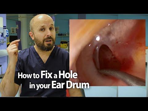 How to fix a Hole in your Ear Drum (tympanoplasty)