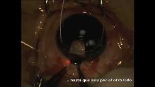 Canaloplastia iTrack - Clínica Oftalmológica Doctor Vila