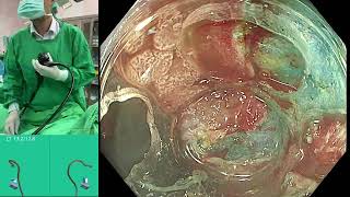 ESD in background colitis, T colon LST G, 5.5 cm