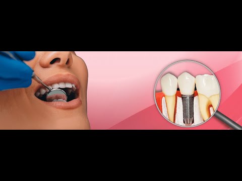 Dental Implant