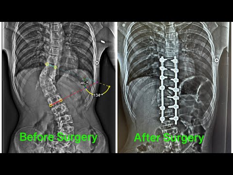 What is scoliosis? How to treat it ? Is surgery safe? - Dr. Ajay Kothari