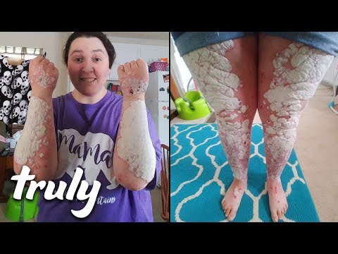 Hogyan lehet gyógyítani a vörös foltokat a lábakon