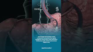 Download lagu Apa Itu Gastroskopi? | Gerlink Medical mp3