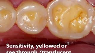 Acid Erosion and your Teeth
