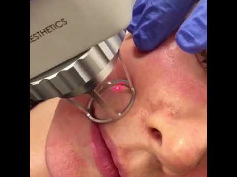 Fractional CO2 Laser Skin Resurfacing