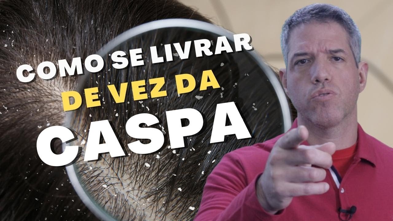 O que CAUSA CASPA e como se livrar dela de FORMA NATURAL?
