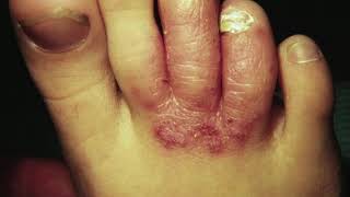 How to Get Rid of Rough Feet with Aspirin