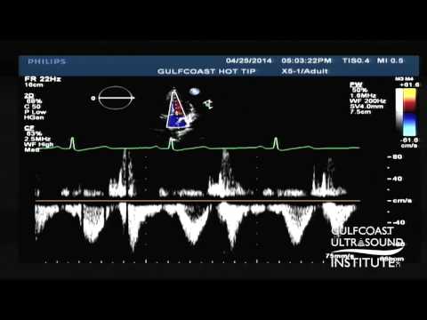 Hot Tips - Calculating the Aortic Valve Area Using the Continuity Equation