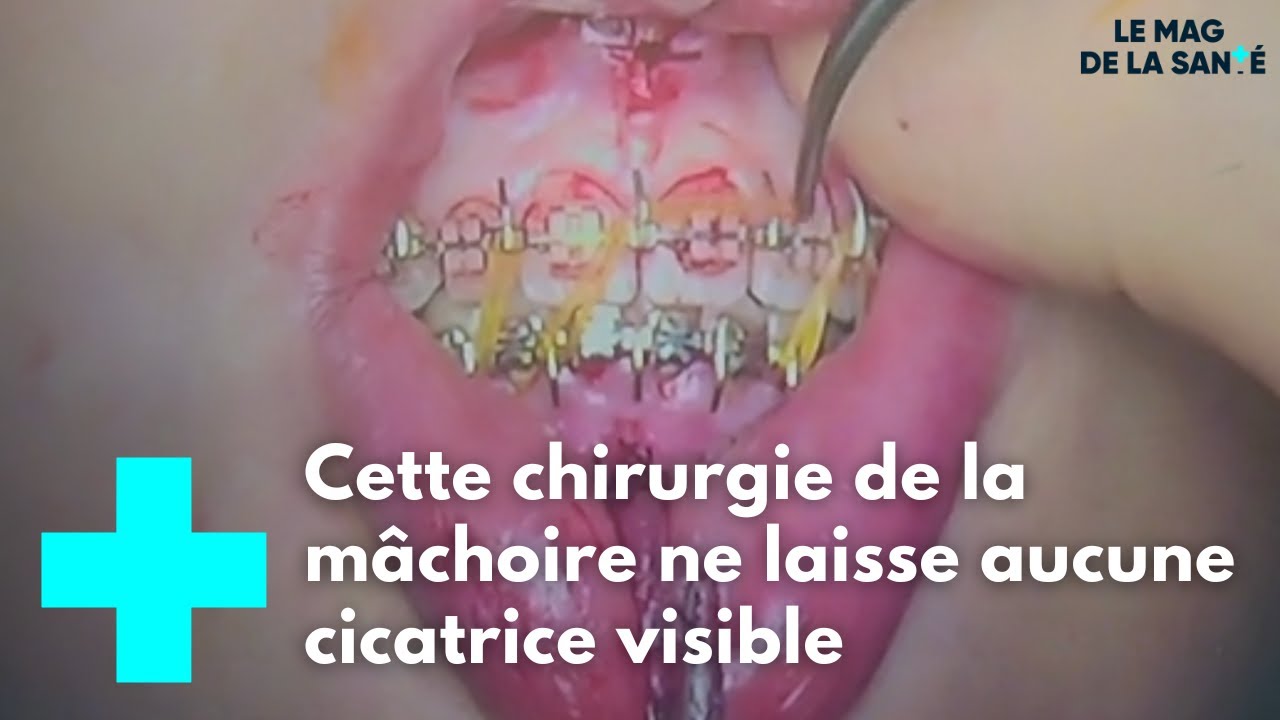 Une chirurgie pour aligner les mâchoires - Le Mag de la Santé?