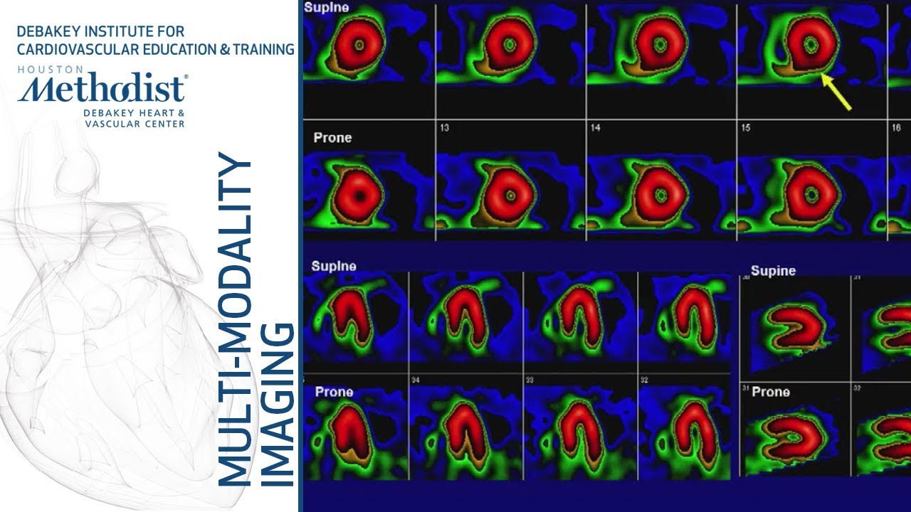 Nuclear Cardiology: Understanding the Basics (John J. Mahmarian, MD) October 16, 2018