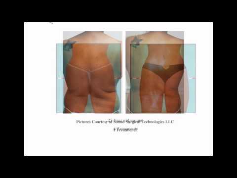 download lagu mp3 mp4 Med Contour Side Effects, download lagu Med Contour Side Effects gratis, unduh video klip Med Contour Side Effects