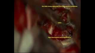 preview picture of video 'HAMEMANGIOBLASTOMA-cerebellum-microsurgical removal-dr suresh dugani/HUBLI/KARNATAK/INDIA'