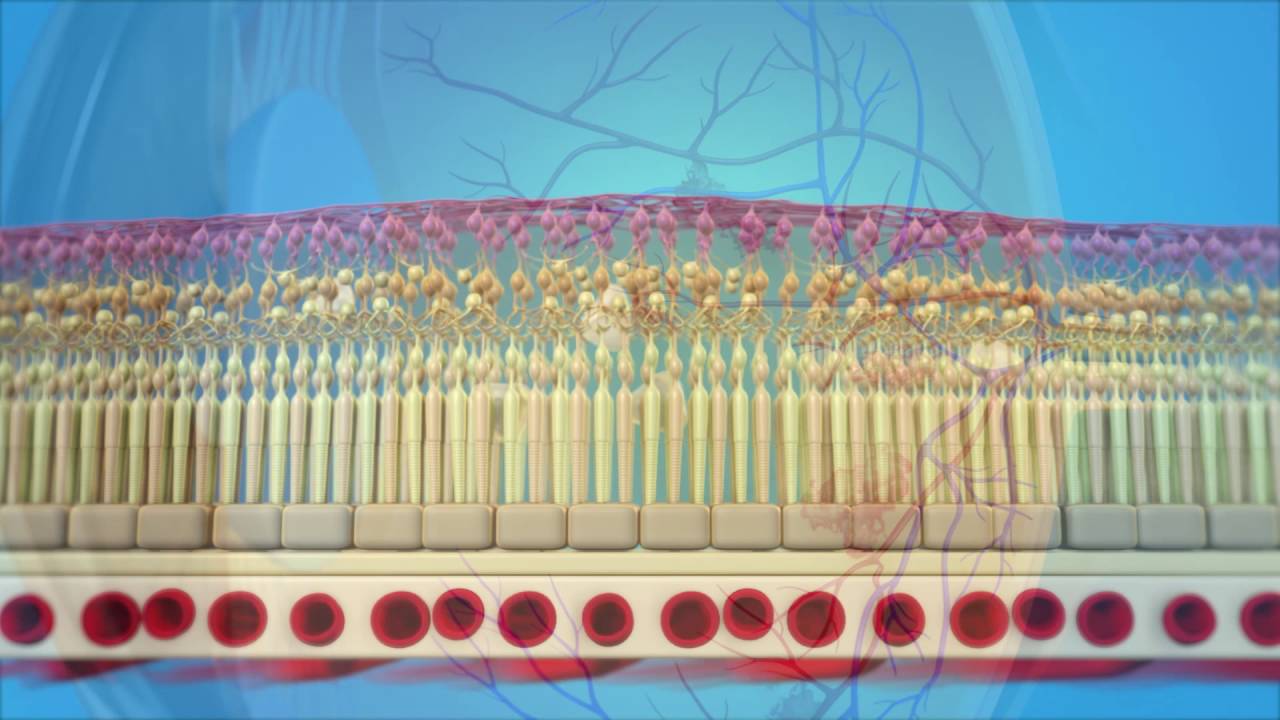 Diabetic Eye Disease: Laser Surgery for Macular Edema