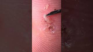 Bicho no pé do Matheus !!Quem aí gosta ??