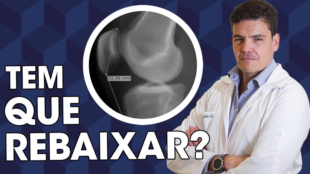 Patela alta tem cura? Tenho que rebaixar ela?