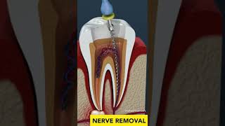 Tooth Cavity &amp; Root Canal