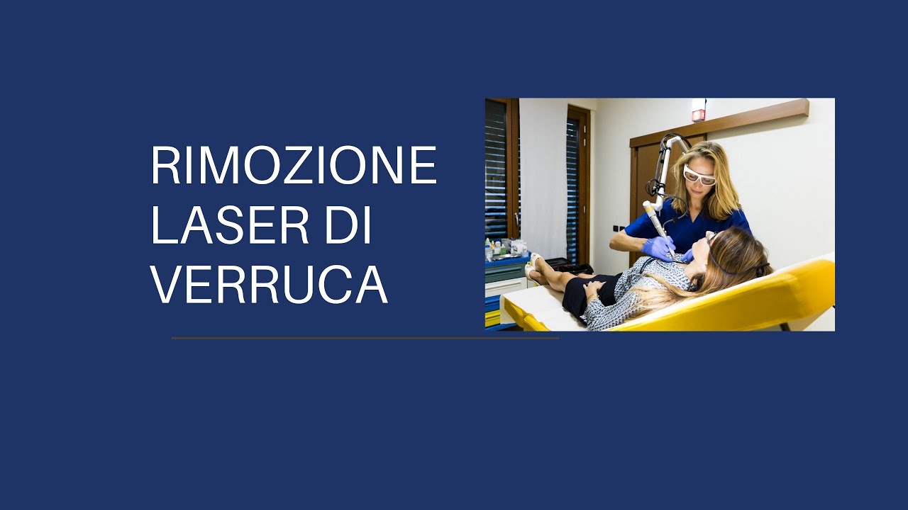 RIMOZIONE LASER DI VERRUCA SUL VISO.