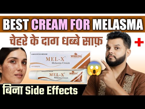 Mel X Cream Review | Best Homeopathic Cream For Melasma
