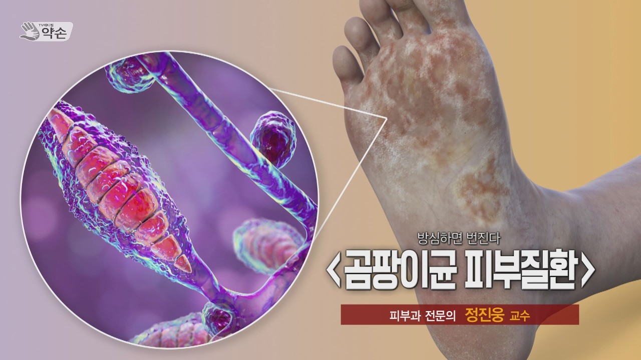 방심하면 번진다! '곰팡이균 피부질환' ㅣ 피부과 정진웅 교수 관련사진