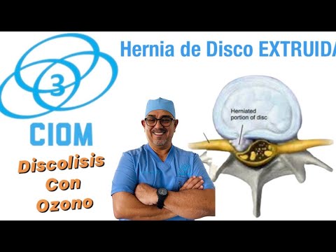 Come trattare posteriore ernia del disco mediana Crema di dolore al collo