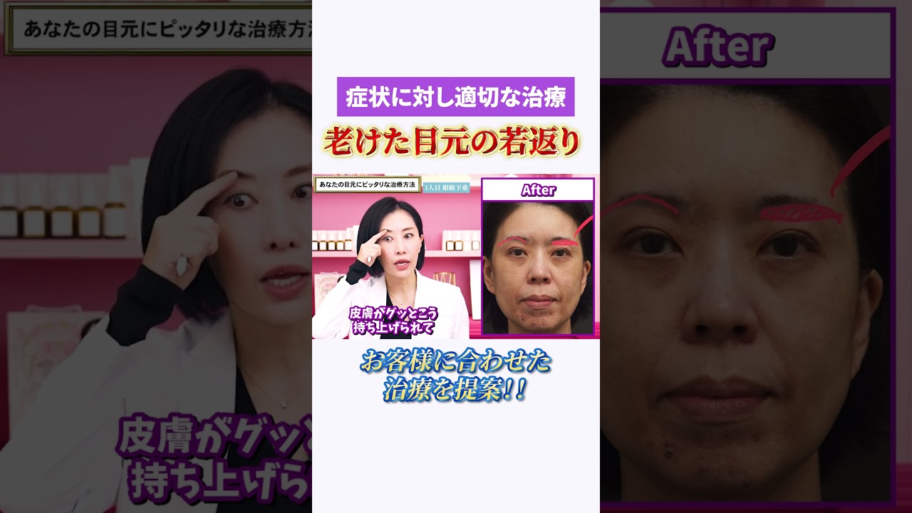 手術？デバイス？あなたの目元老けにピッタリな治療方法！