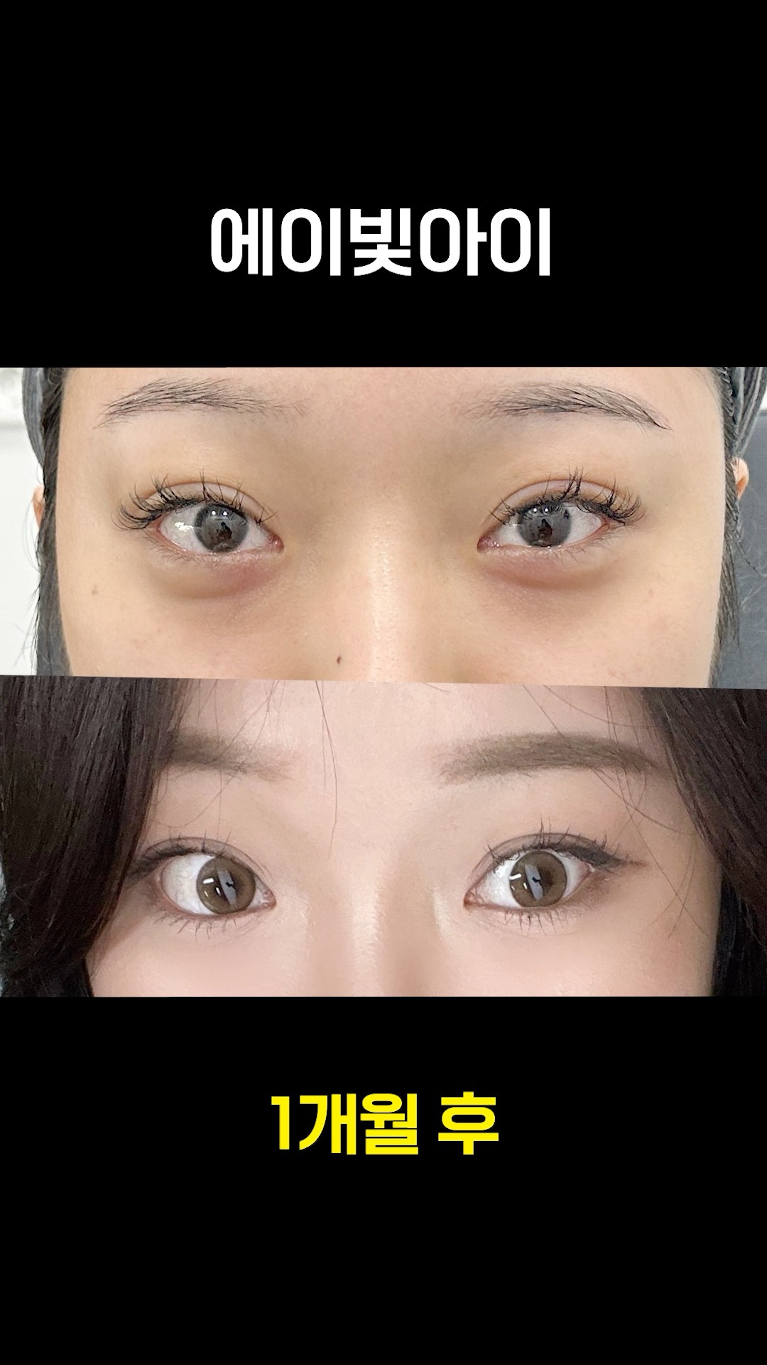 에이빛아이로 다크서클 순삭 ✔️