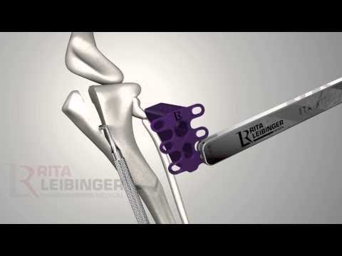 10,000 Happy Dogs: The 3D Printed TTA RAPID™ Implant