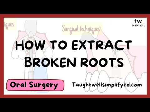 4 Ways To Extract Broken Root Tips And When To Leave Them Alone