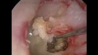 Transcanal endoscopic approach for attical cholesteatoma