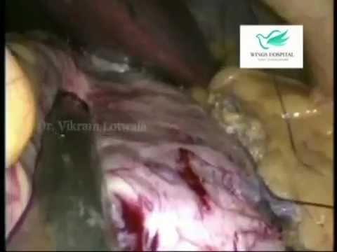 Laparoscopic Sleeve Gastrectomy
