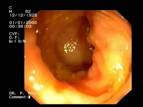 Medicine per eliminazione di vermi a un gattino Analisi di ptsr helminths