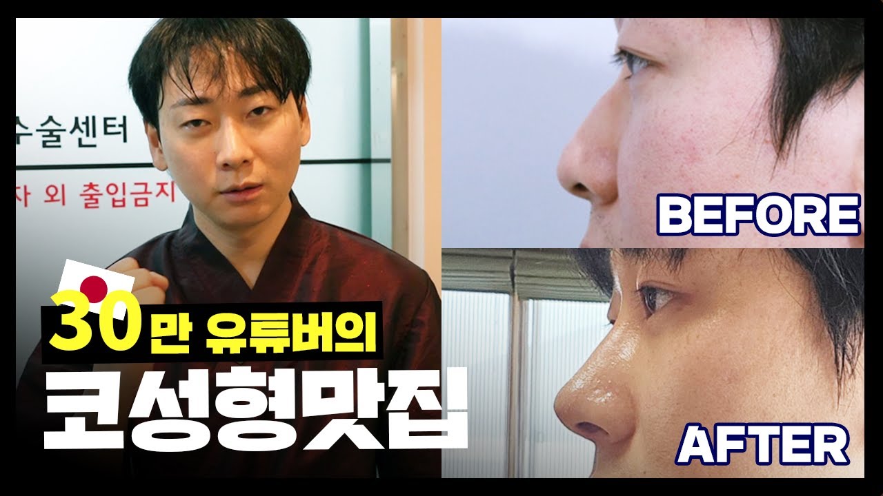 30만 유튜버 코성형맛집 방문기ㅣ남자코성형ㅣ코성형후기ㅣ성형브이로그