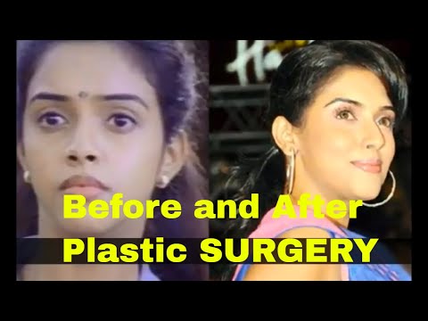 download lagu mp3 mp4 Asin Plastic Surgery, download lagu Asin Plastic Surgery gratis, unduh video klip Asin Plastic Surgery